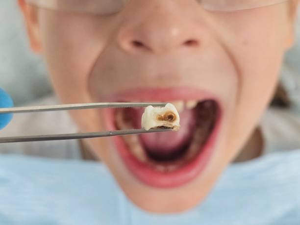 Best Root Canal Emergency Dentist  in Manor, TX